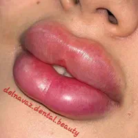 کامپوزیت دندان ژل و بوتاکس پی آرپی و لیفت نخ|خدمات آرایشگری و زیبایی|اهواز, نادری|دیوار