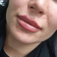 فیشیال مردانه تخصصی + بوتاکس و مزوتراپی|خدمات آرایشگری و زیبایی|رفسنجان, |دیوار