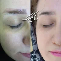پاک کردن خالکوبی، تتو بدن و ابرو با لیزر کیوسوئیچ|خدمات آرایشگری و زیبایی|ارومیه, |دیوار