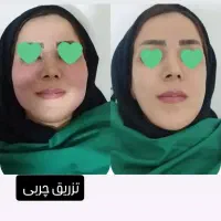 لیپوساکشن|خدمات آرایشگری و زیبایی|بروجرد, |دیوار