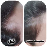 پک ریزش مو برای اولین بار در ایران|آرایشی، بهداشتی، درمانی|قم, چهار مردان|دیوار