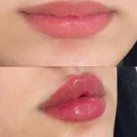 اف ۵۰٪ مطب پوست مو لیزر الکساندرایت