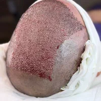 کاشت مو ی پر تراکم