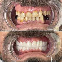 ارتودنسی ،زیبایی،ایمپلنت با تخفیف پاییزی|خدمات آرایشگری و زیبایی|مرند, |دیوار