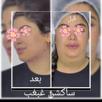 آف عمل بلفارو . وتزریق چربی