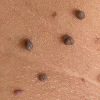 خال برداری حذف زگیل خال زگیل زگیل تناسلی غده چربی