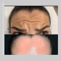 لب روسی پروفیس .جوانسازی.  پزشک|خدمات آرایشگری و زیبایی|اهواز, زیتون کارمندی|دیوار