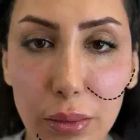 جشنواره بزرگ تزریق جربی دست صورت وبیکینی