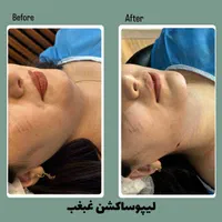 لیپو ساکشن غبغب و بوکال فت ( + شرایط )|خدمات آرایشگری و زیبایی|مشهد, گلبرگ شمالی|دیوار
