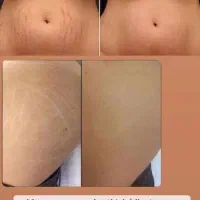 کرم استرچ مارک