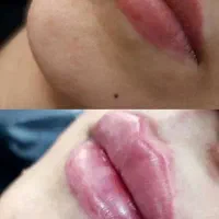 ژل بوتاکس گلوتاتیون سفید کننده بمدت ۳ روز خاش|خدمات آرایشگری و زیبایی|خاش, |دیوار