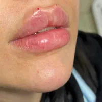 جشنواره پی آرپی ژل و بوتاکس مزوتراپی بلفارو