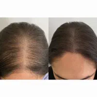 قطع فـوری ریزش موی شما