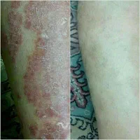 درمان پیسی / پسوریازیس/ مشکلات پوستی و ایمنی|آرایشی، بهداشتی، درمانی|مشهد, شهرک رازی (شهرک غرب)|دیوار