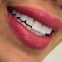 کامپوزیت و لمینت کلینیک دندانپزشکی آرمی|خدمات آرایشگری و زیبایی|تهران, شکوفه (عبدل آباد)|دیوار