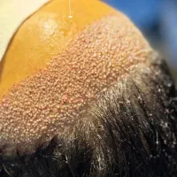 کاشت مو در امیدیه با بهتیرین کیفیت