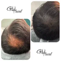 میکرواسکالپ سر، میکروبلیدینگ ابرو، شیدینگ لب|خدمات آرایشگری و زیبایی|شاهین‌شهر, فردوسی|دیوار