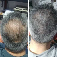 ریزش مو دیگه بسه
