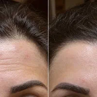 بوتاکس هالیوودی(نچرال)