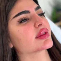 تخفیف ژل و فیلر فول فیس 3900 به جای ۷/۹۰۰|خدمات آرایشگری و زیبایی|اصفهان, خانه اصفهان|دیوار