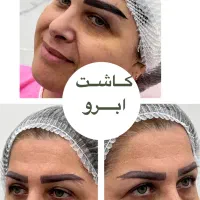 کاشت ابرو و مو با تیم تخصصی در کلینیک معتبر|خدمات آرایشگری و زیبایی|رشت, بوسار|دیوار