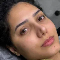 میکروبلیدینگ و فیبروز صورت بدون درد و خونریزی|خدمات آرایشگری و زیبایی|گلبهار, شهر جدید گلبهار|دیوار