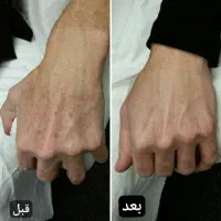 جوانسازی پوست با پی ارپی ،اگزوزوم ،مزوژل و.