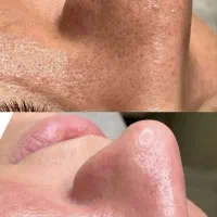 پاکسازی تخصصی کامل پوست پنجشنبه تا شنبه فقط 500