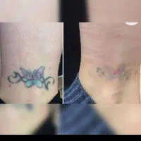 پاک کردن تتو و کربن تراپی با دستگاه پیکوشور|خدمات آرایشگری و زیبایی|کرمانشاه, |دیوار