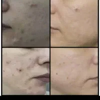 آموزش فیشیال تخصصی و مزوو