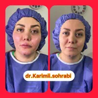 لیپو ابدو ژل بوتاکس کاشت ،غبغب، بلفارو،تزریق چربی|خدمات زیبایی و سلامت|تهران, شمسآباد|دیوار