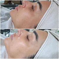 پاکسازی و فیشال تخصصی پوست در شهرری|خدمات زیبایی و سلامت|تهران, فیروزآبادی|دیوار