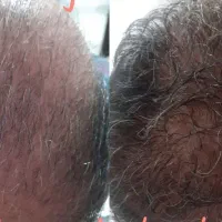 مزوتراپی بعد از کاشت در مطب پزشک خانم