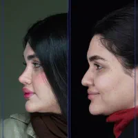 لیپوساکشن ۳۶۰ ابدومینو پلاستی در شیراز +وام