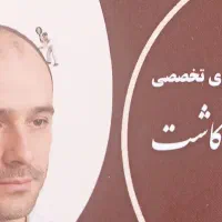 کاشت مو در شهرستان چابهار