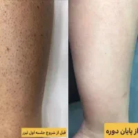 لیزر فول بادی ۶۱۰ تومان قیمت ویژه در مهلت محدود|خدمات آرایشگری و زیبایی|شهریار, شهرک وائین|دیوار