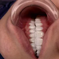 لمینیت دندان با تخفیف ویژه