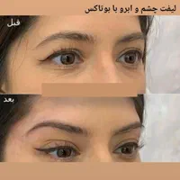 تزریق ژل بوتاکس چربیسوزی آنزیم جوانسازی|خدمات آرایشگری و زیبایی|اهواز, کیانپارس |دیوار