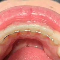 نگهدارنده ثابت ارتودنسی