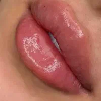 بوتاکس