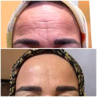 جشنواره تخفیف بوتاکس و فیلر و مزوژل prp