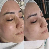 فشیال تخصصی vip پوست به مدت 3 روز فقط 170 تومن|خدمات آرایشگری و زیبایی|مشهد, آزادشهر|دیوار