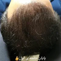 میکرواسکالپ / اسکالپ جایگزین کاشت مو تضمینی|خدمات آرایشگری و زیبایی|مشهد, شهید فرامرز عباسی|دیوار