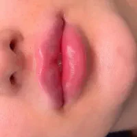 خدمات ژل و بوتاکس ومزو...