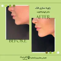 تزریق فیلر زیر چشم|خدمات آرایشگری و زیبایی|تهران, جردن|دیوار