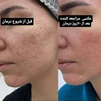 خالبرداری پلاسما درمان ککُ مک و منافذ فیشیال تخصصی|خدمات آرایشگری و زیبایی|مرودشت, گندم‎|دیوار