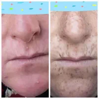برداشتن انواع خال کک مک لک بادستگاه پیشرفته|خدمات آرایشگری و زیبایی|کازرون, |دیوار