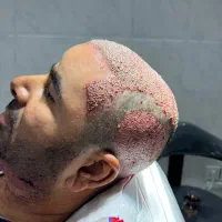 آموزش و استخدام تکنسین کاشت مو