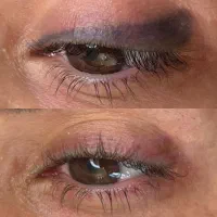 ریموو(پاک کردن تاتو) صورت وبدن با لیزر پیشرفته|خدمات آرایشگری و زیبایی|تبریز, |دیوار