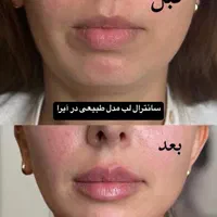 افتادگی پلک،بلفاروپلاستی،سانترال لب،بوکال فت،غبغب|خدمات آرایشگری و زیبایی|تهران, پاسداران|دیوار